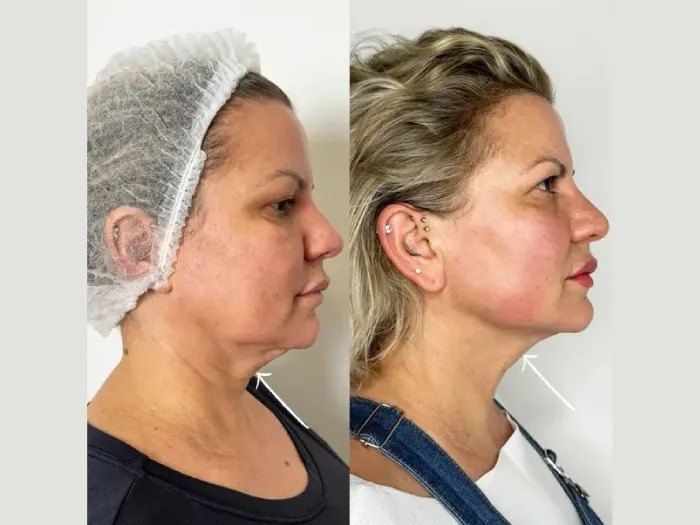 Endolift Doctors in Dubai