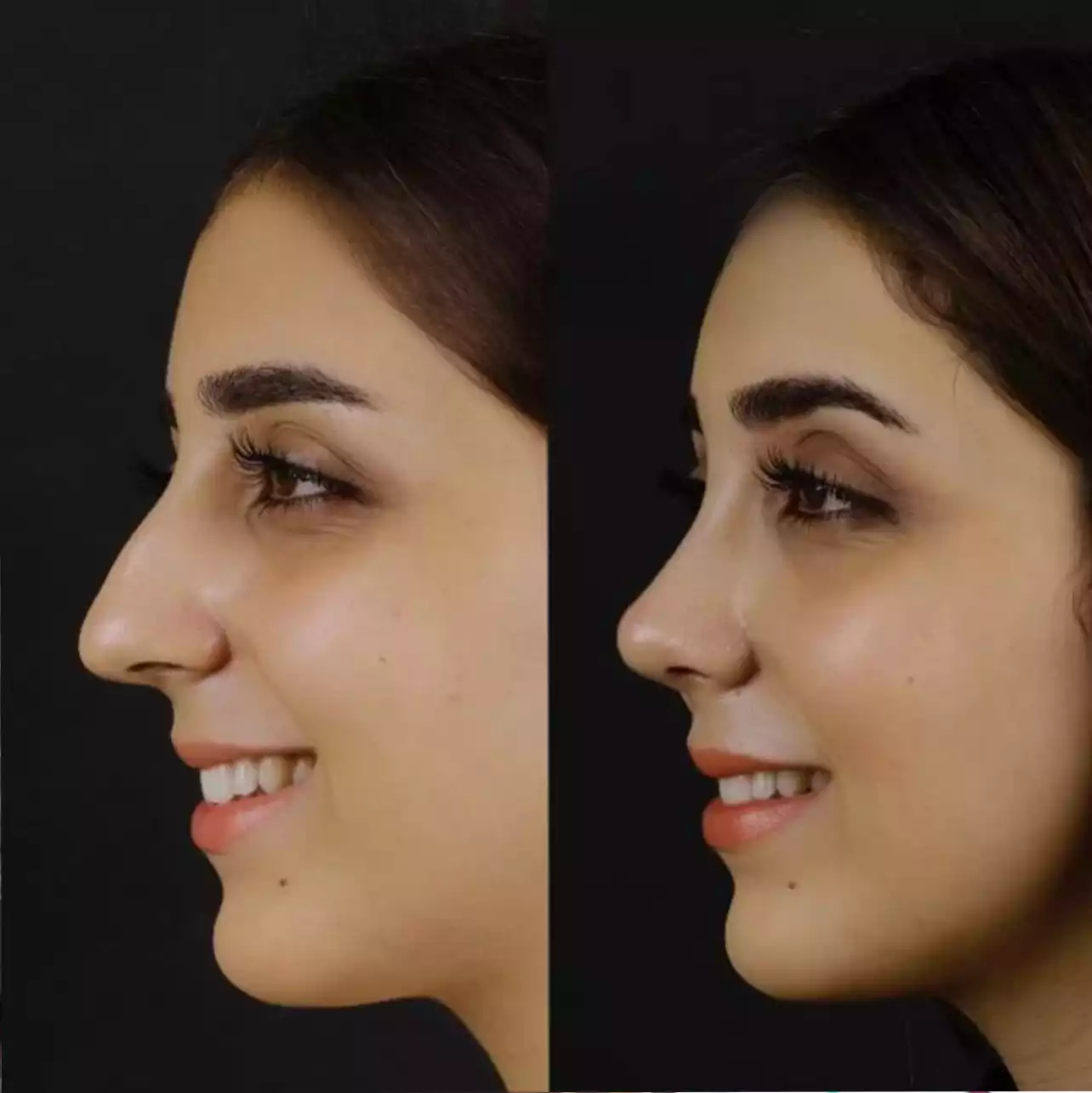Looking for the Best Doctors in Dubai for Hooked Nose Rhinoplasty?