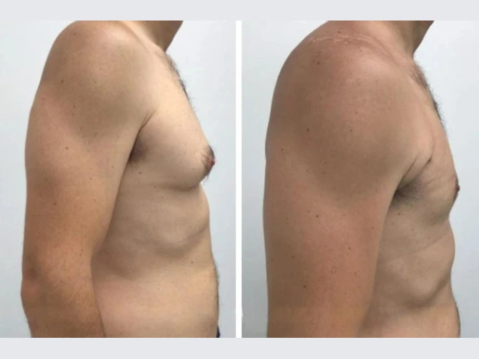 Best Doctors in Dubai for Gynecomastia in Dubai
