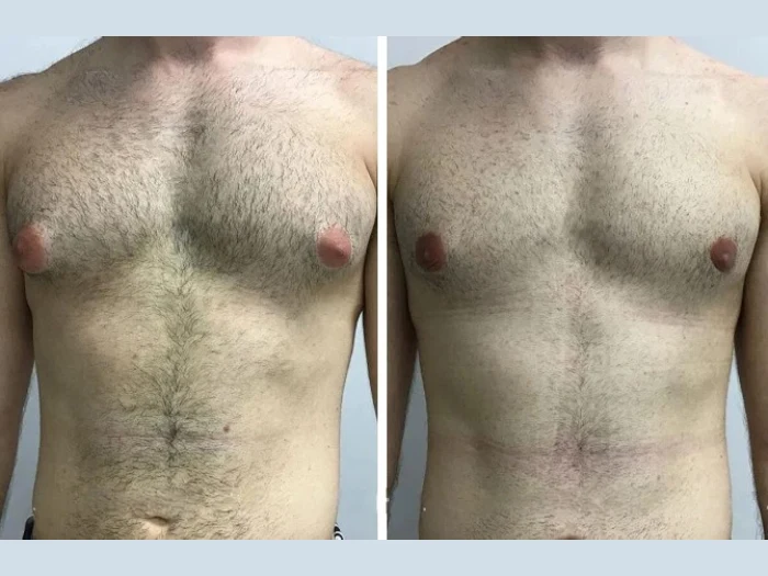 Best Gynecomastia Surgeon in Dubai: Addressing Common Patient Concerns