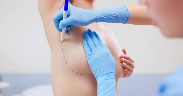 Is Silicone Breast Implants Worth It
