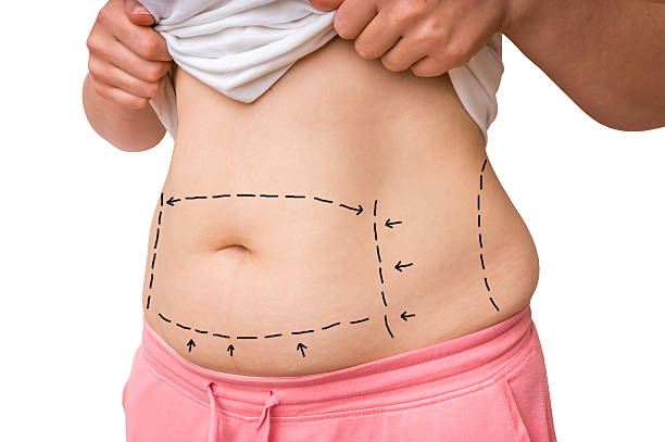 Lipo Abdominoplasty Surgery