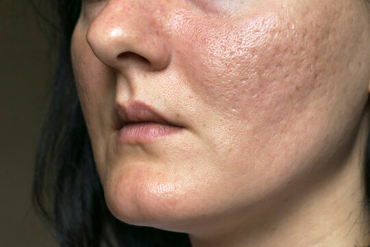 Acne Scar Treatment In Islamabad