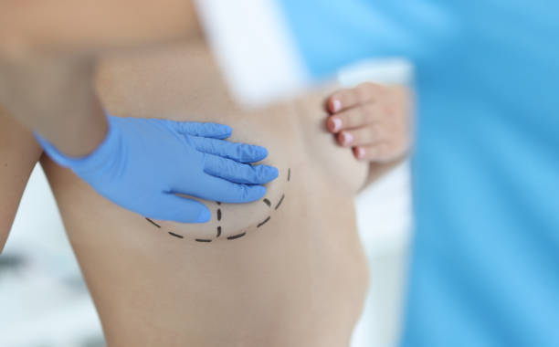 What to Expect with Silicone Breast Implants ?