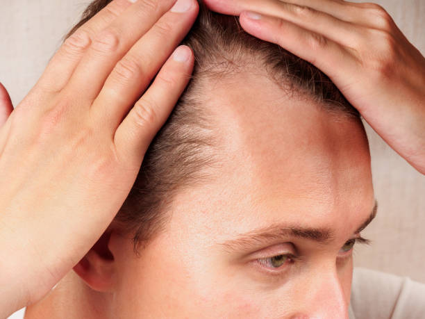كل ما تريد معرفته عن زراعة الشعر في الرياض