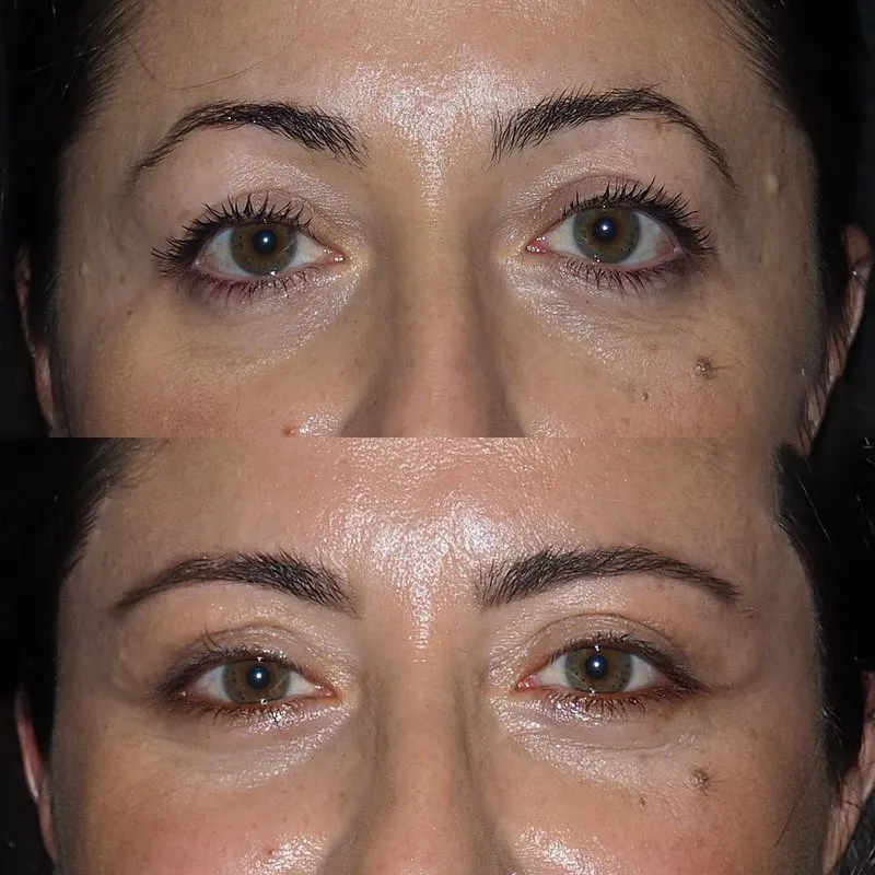 Daily Life One Week After Eye Bag Removal Surgery in Dubai