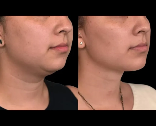 Can Double chin removal surgery in Dubai change your facial expression?