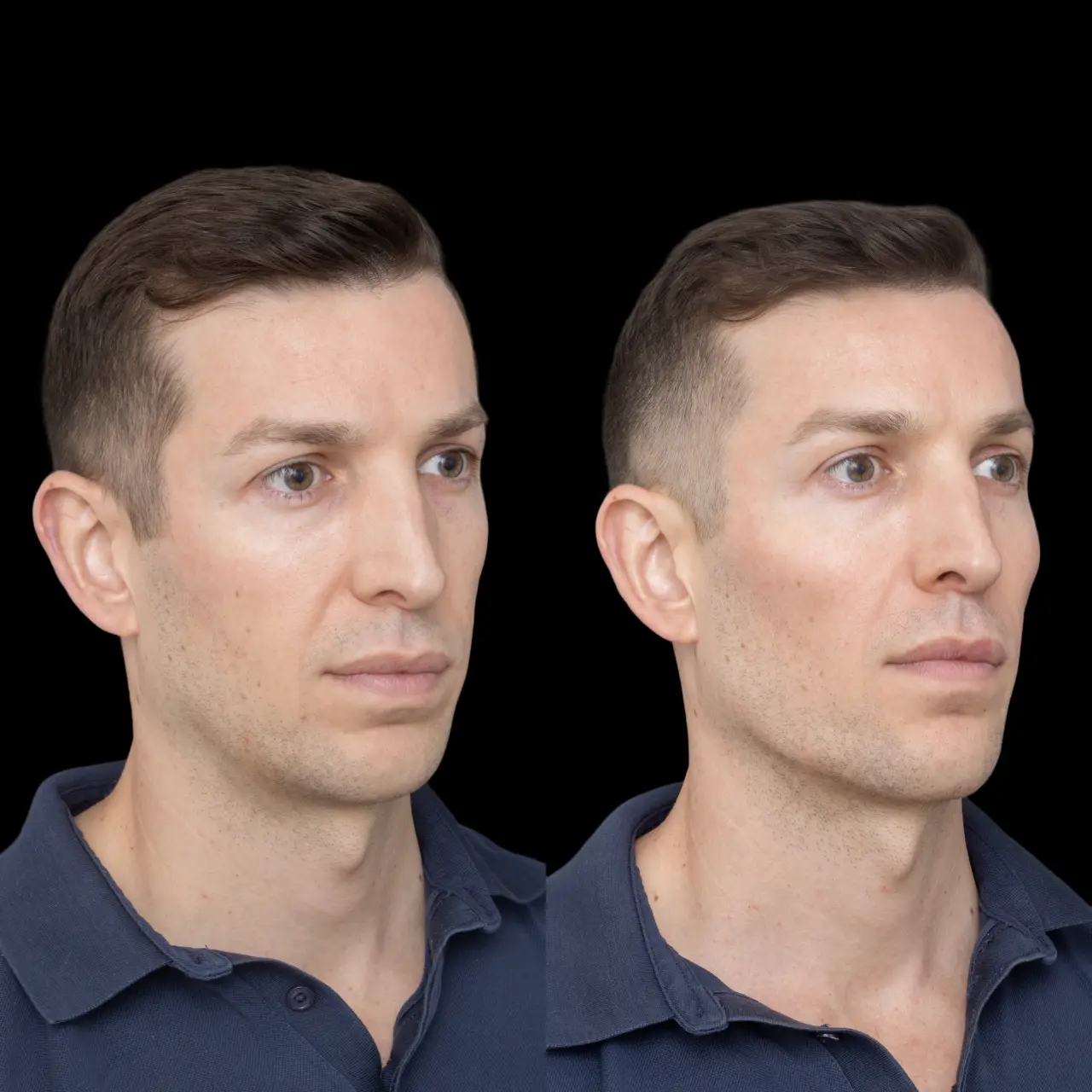 The Science of Jawline Fillers at the Best Aesthetic Clinic in Dubai