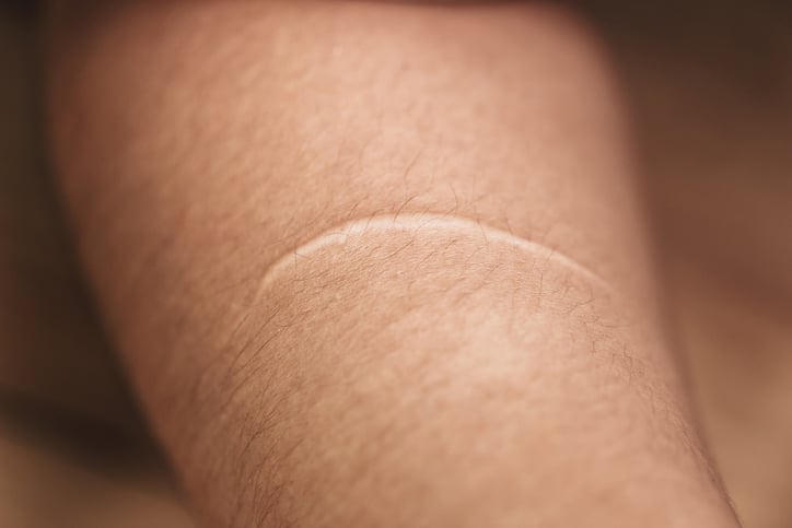 How Surgical Scar Revision Restores Skin Smoothness