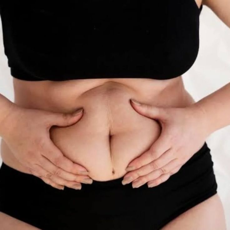 Best Liposuction Techniques Available in Riyadh
