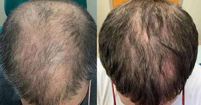Restore Natural Growth with Exosome Hair Therapy in Islamabad