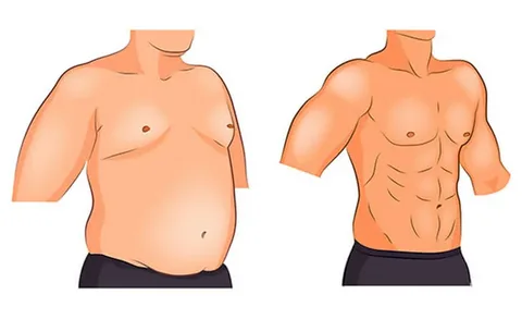 Best Surgeon For Gynecomastia in Islamabad – Expert Care for Lasting Results