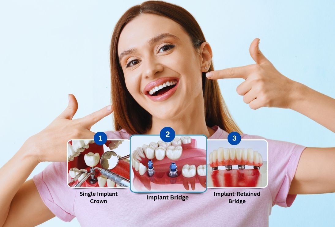 Can Dental Implant in Islamabad Last a Lifetime?
