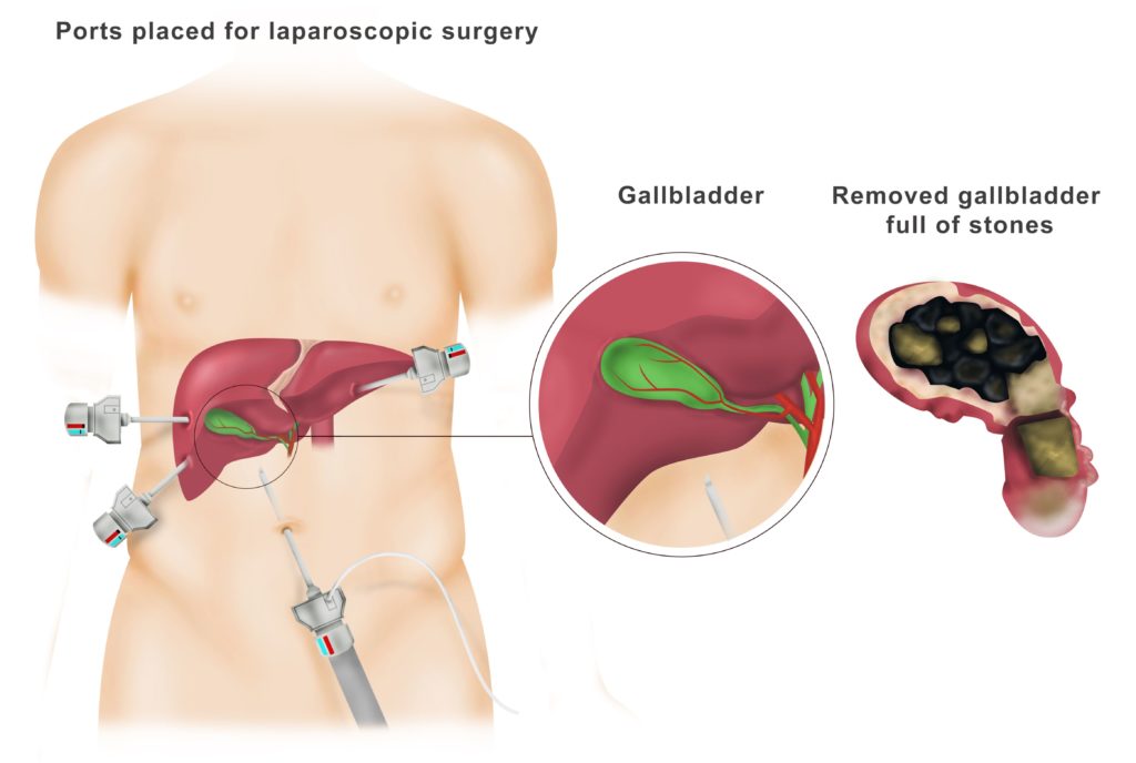 gallbladder specialist singapore