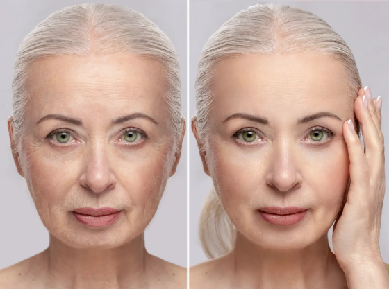 Botox affects under-eye bags before and after