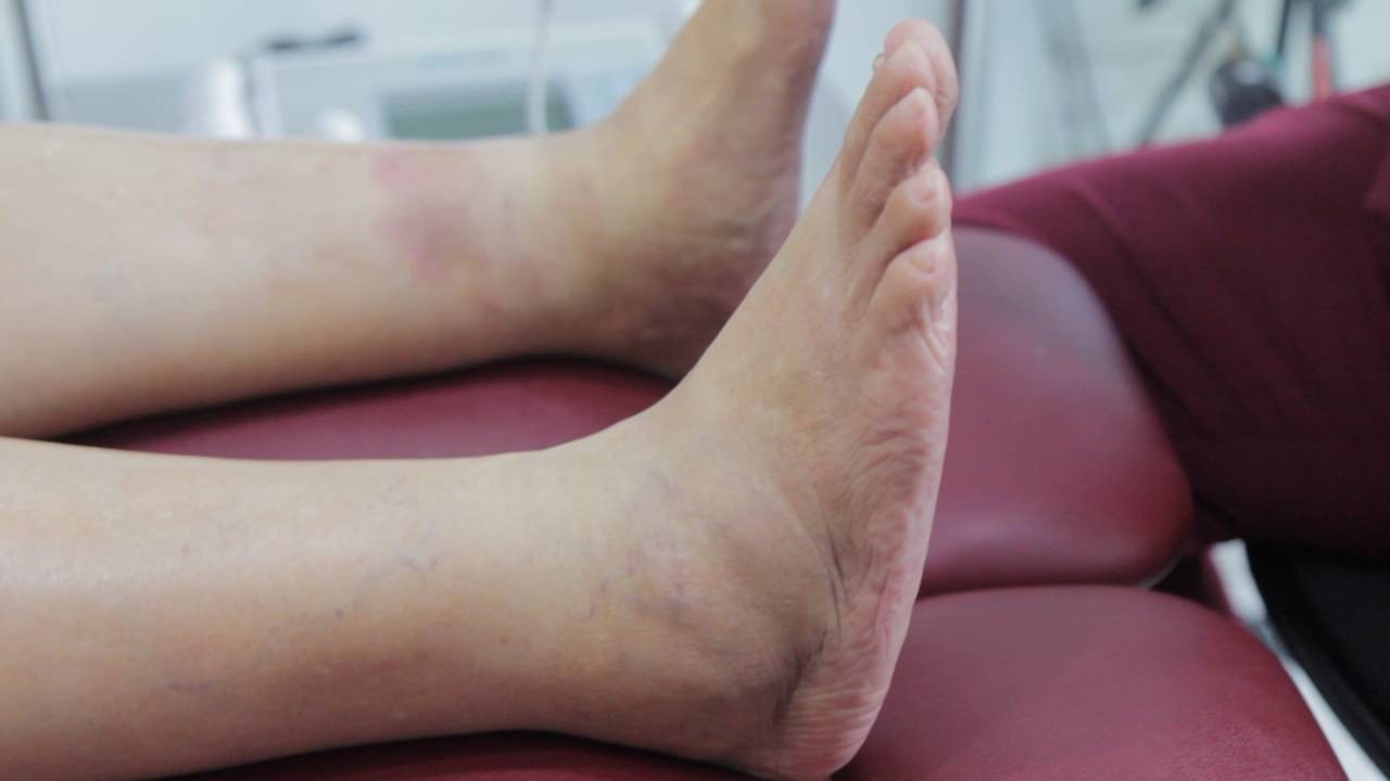 Diabetes Foot Singapore