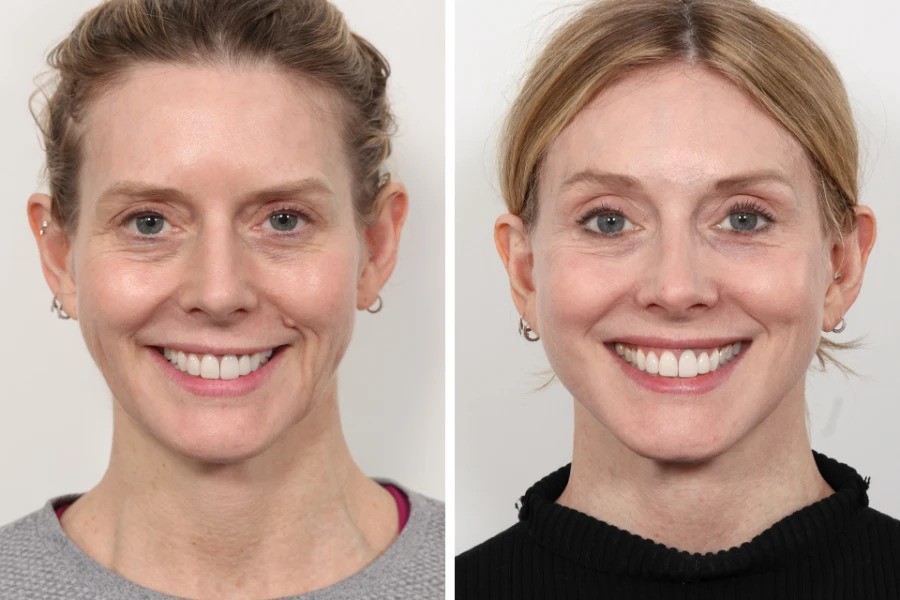 Thread Lift Treatments in Dubai for Skin Tightening