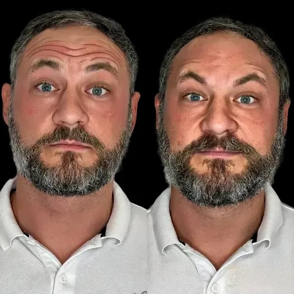 Profhilo treatments in dubai