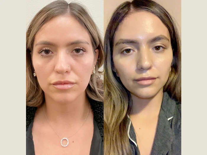 Thread Lift: Best Doctors in Dubai for Quick, Safe, and Stunning Results