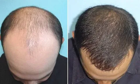 Hair Transplant in Dubai