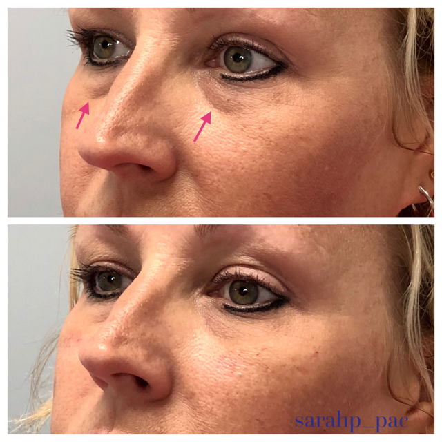 Best treatment for undereyes Chicago