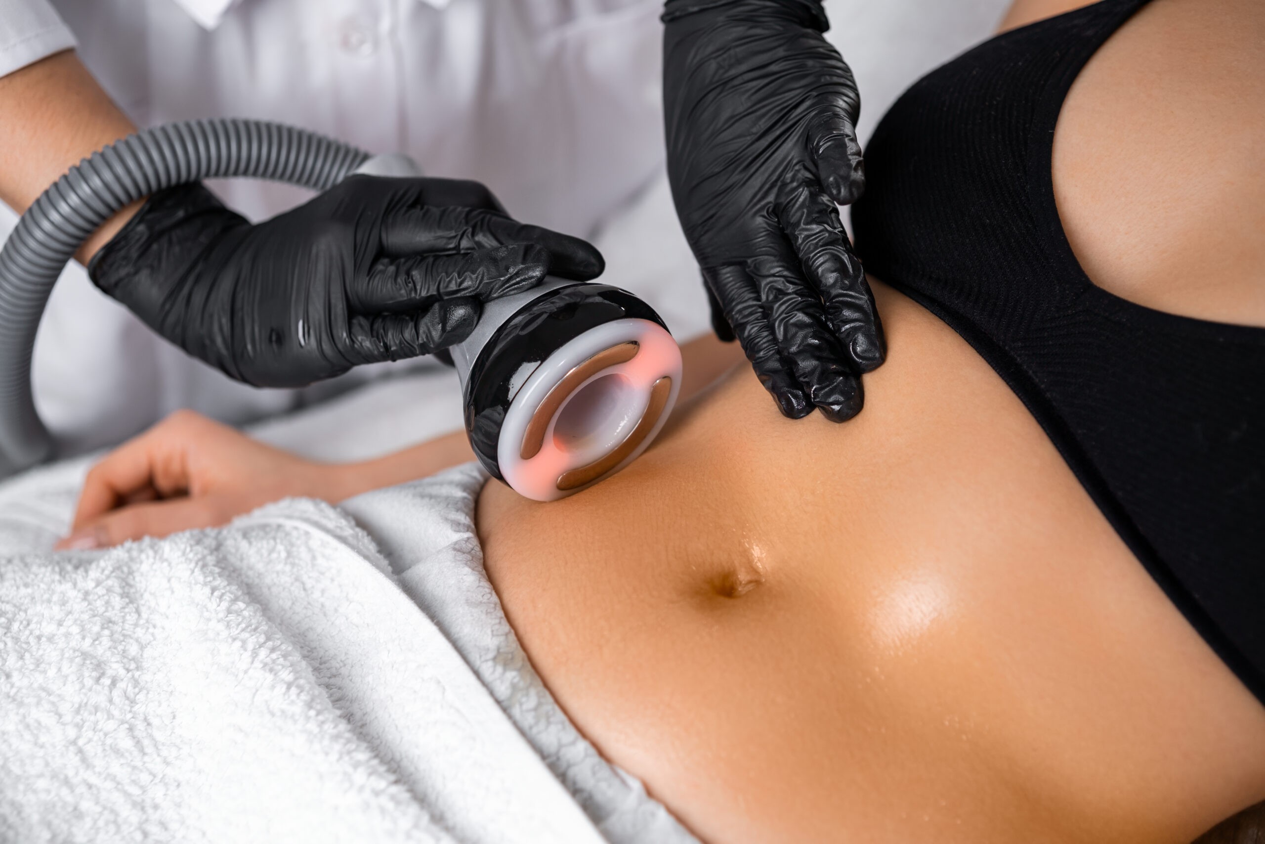 Laser liposuction