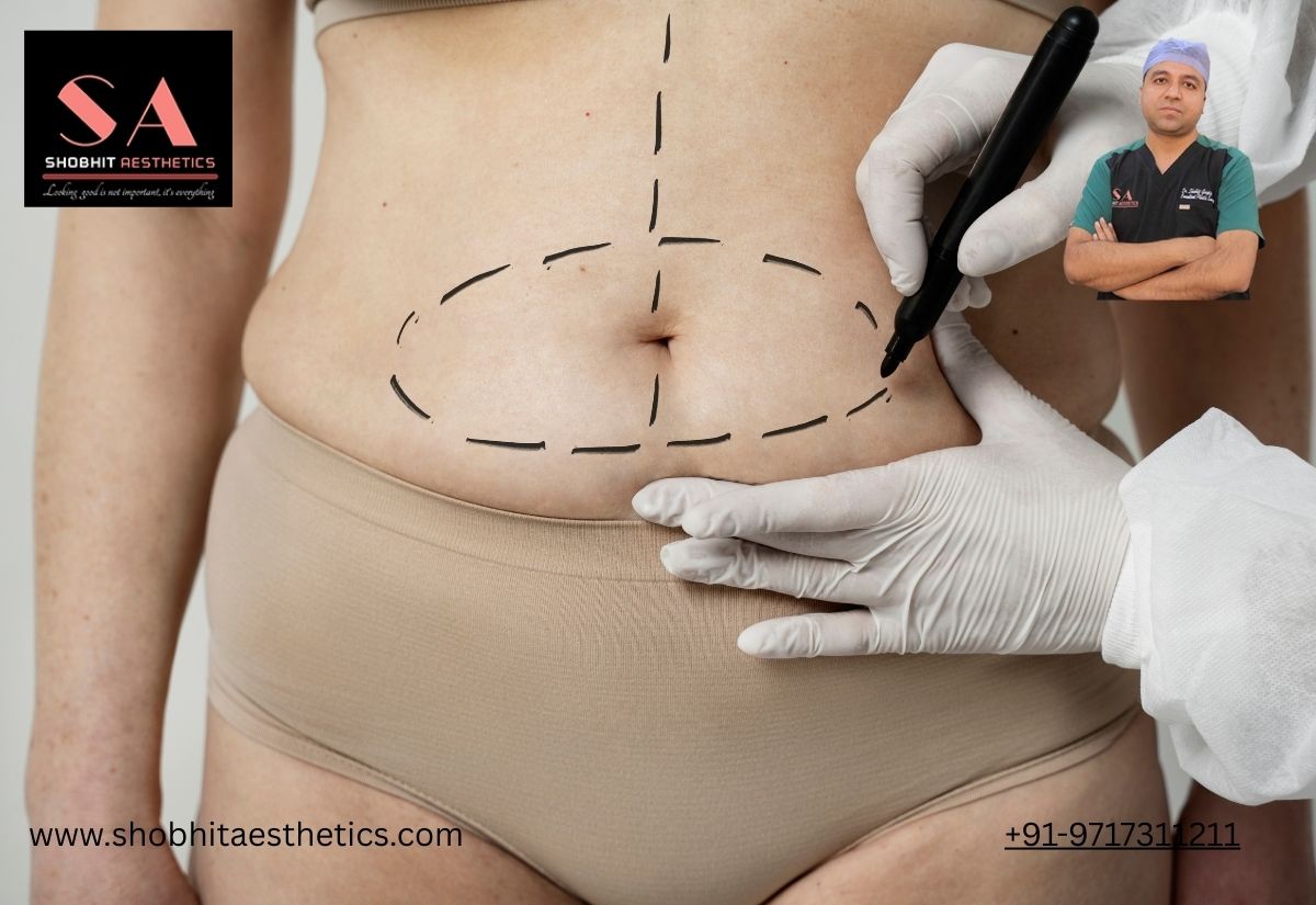 Liposuction Surgery in Delhi