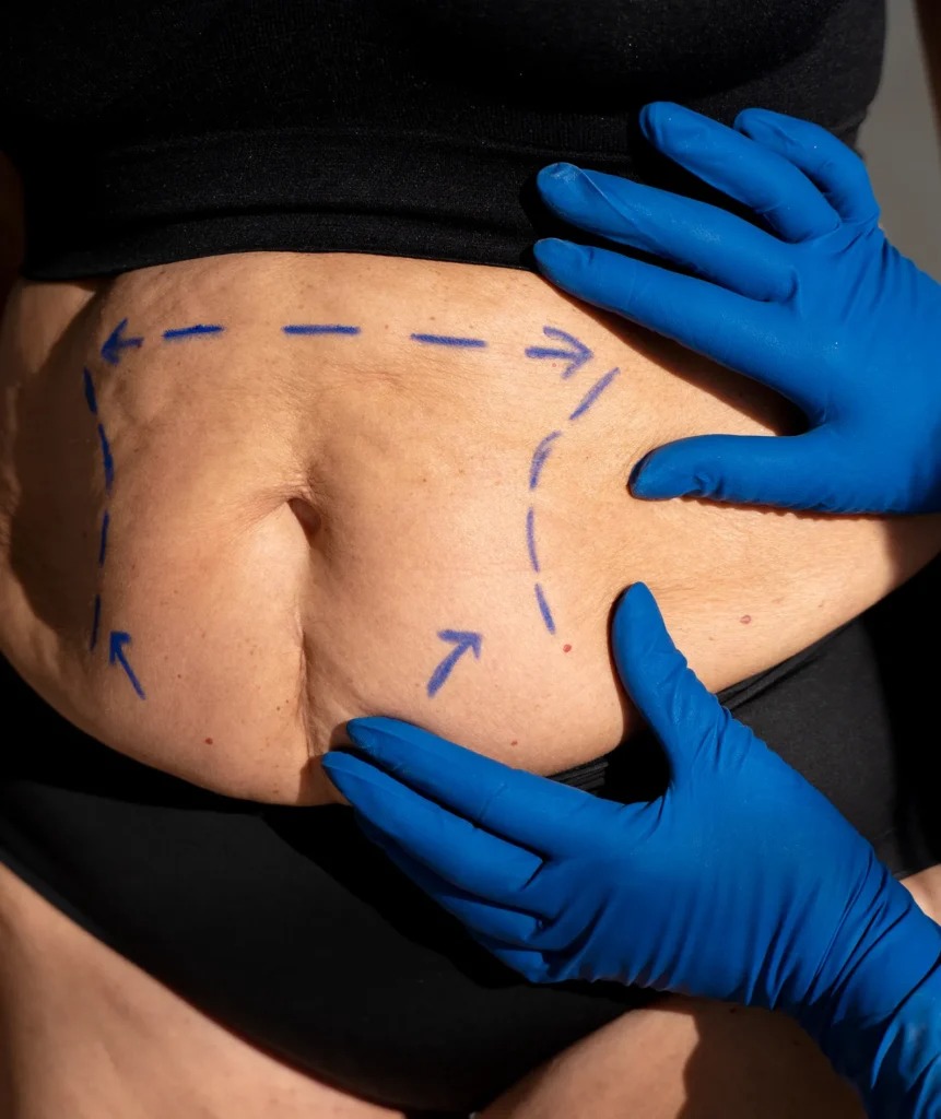 Liposuction in Dubai