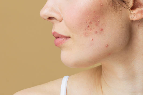 Pimples Treatment in Riyadh