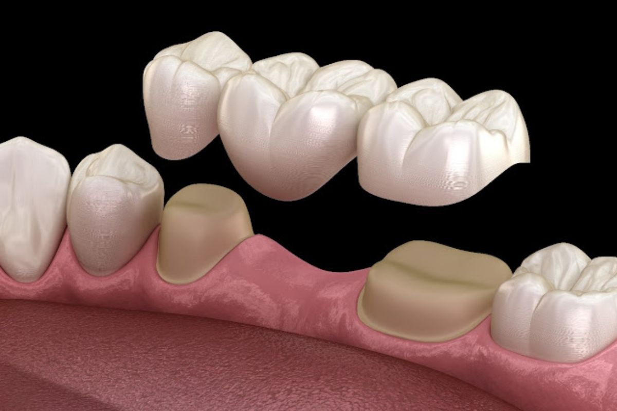 Dental Bridges in Chandler, AZ
