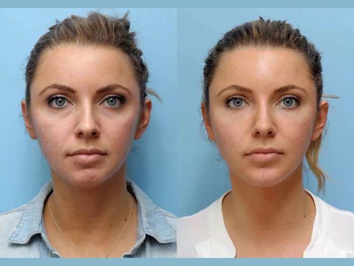 Revitalize Your Look with a Thread Lift at the Best Aesthetic Clinics in Dubai