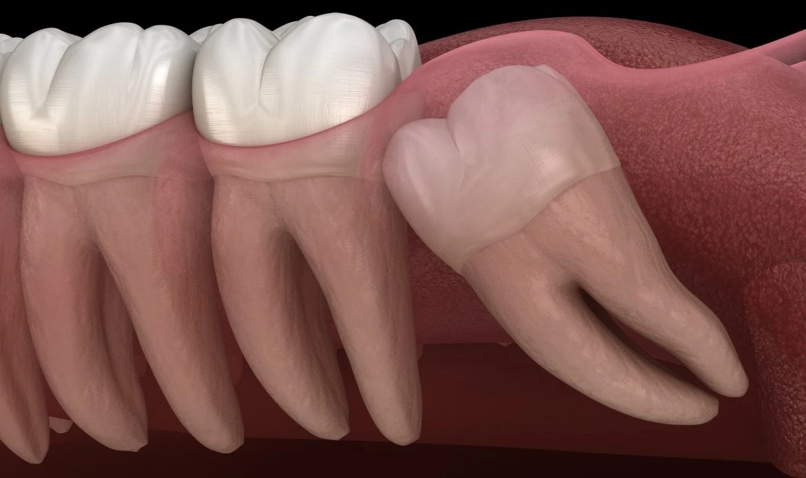 Wisdom Teeth Removal in Chandler, AZ