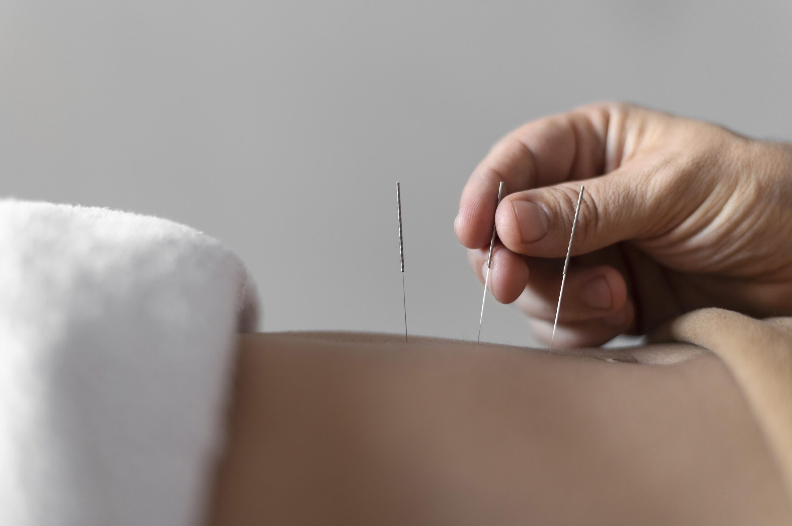 chinese medicine acupuncture