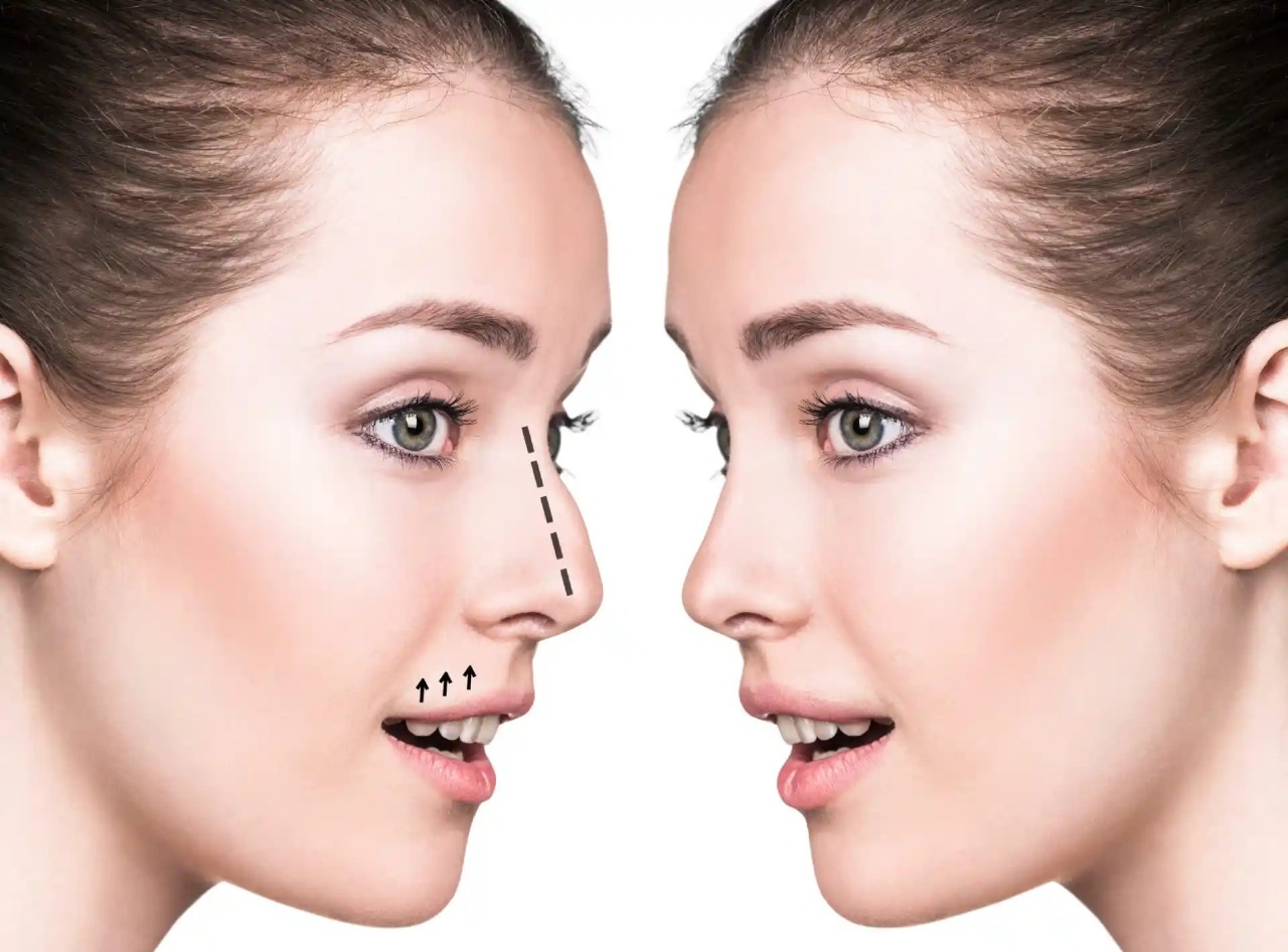 Septoplasty in Dubai