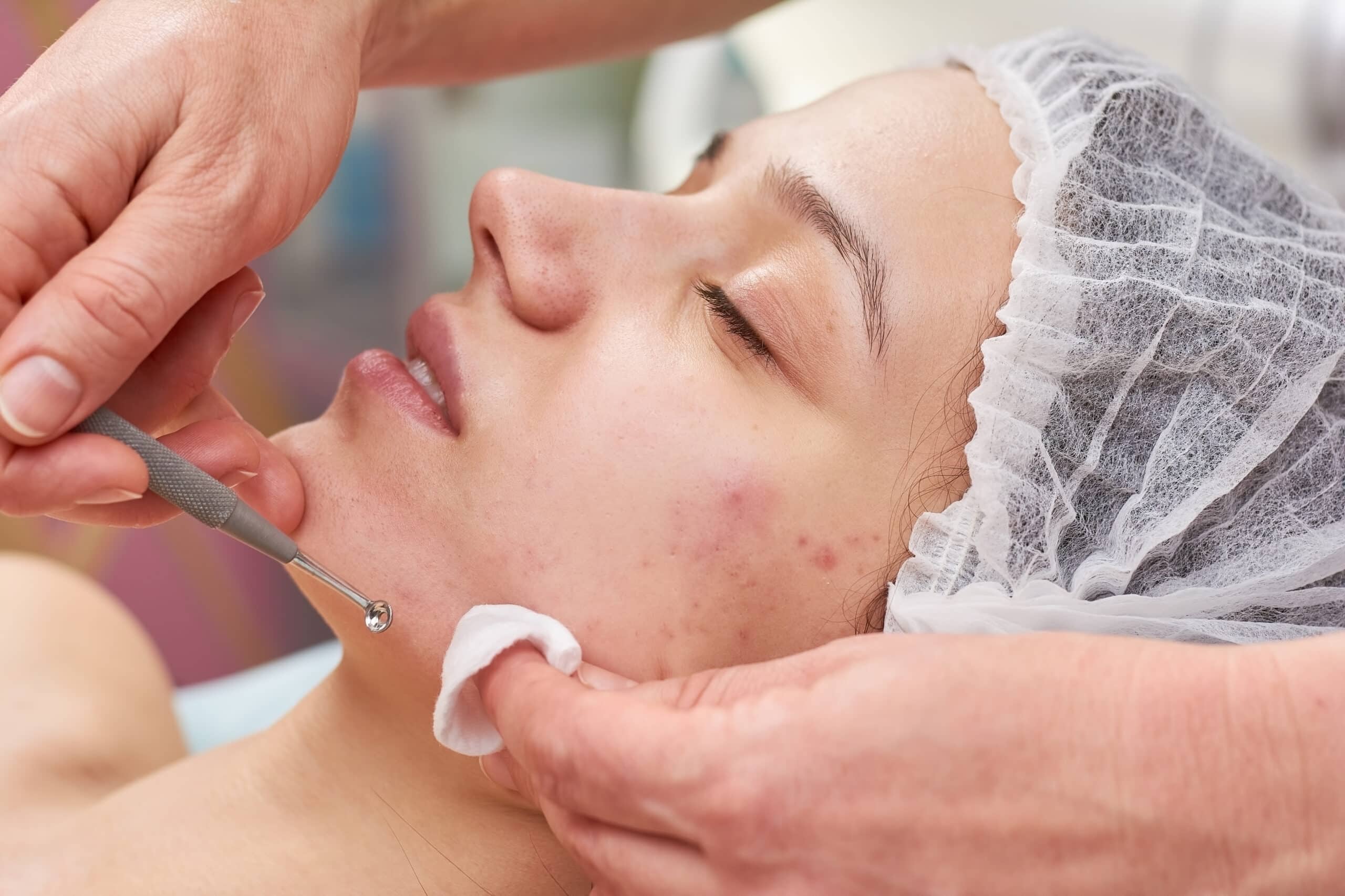 pimples treatment in Islamabad