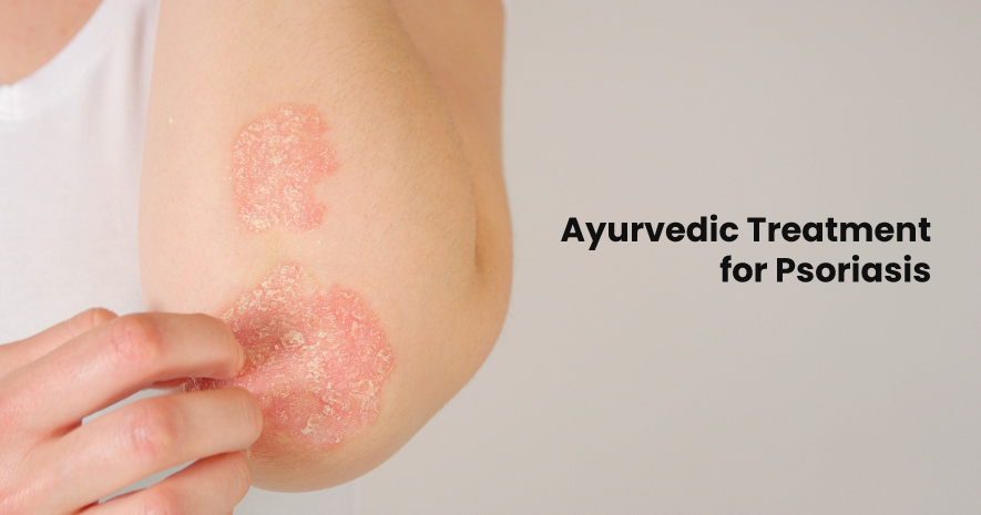 Ayurveda for psoriasis