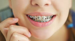 Dental Braces in Islamabad1