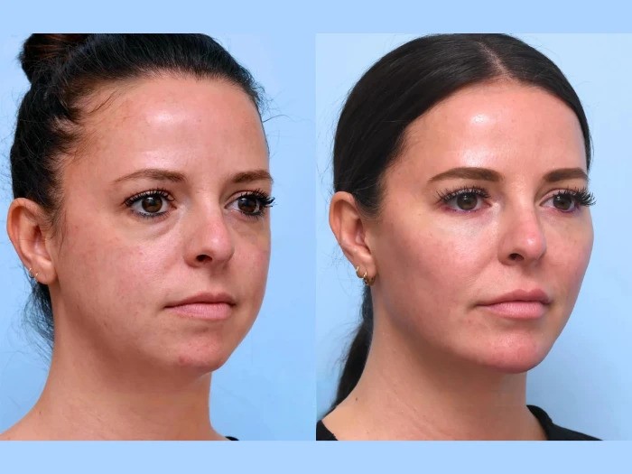 Smooth Wrinkles and Fine Lines Instantly Using Thread Lift Treatment in Dubai