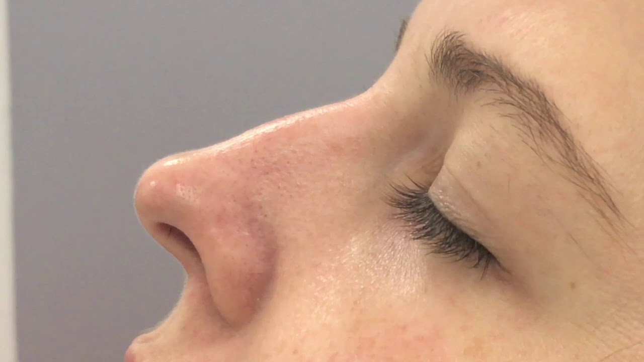 Liquid Rhinoplasty for Smooth, Defined Nose Contours