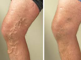 Varicose veins treatment in ayurveda​