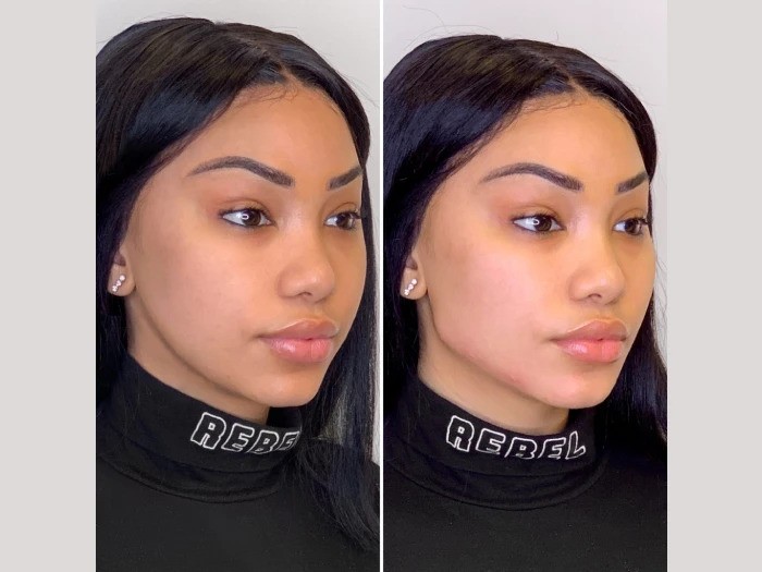 Thread Lift Expertise from the Best Doctors in Dubai