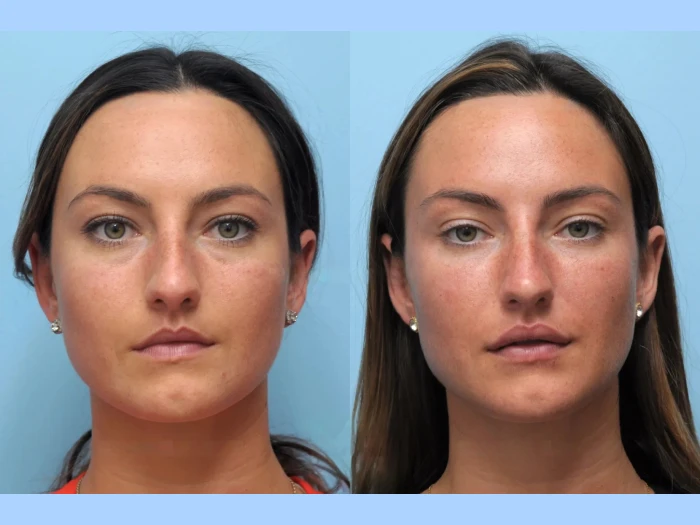 Experience Facial Renewal at the Best Aesthetic Clinics in Dubai for Thread Lift