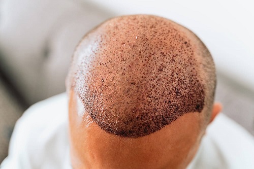 زراعة الشعر في الرياض