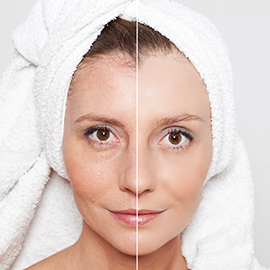 prp treatment for face before after